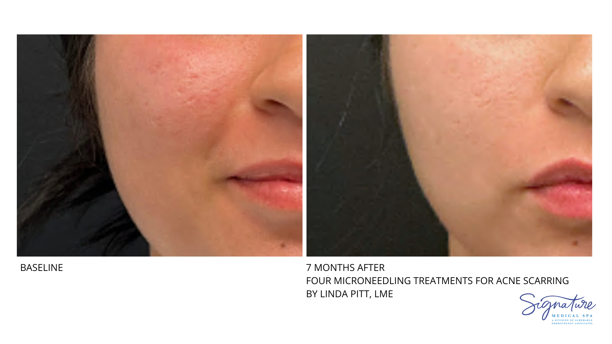 Before and After Image: Microneedling