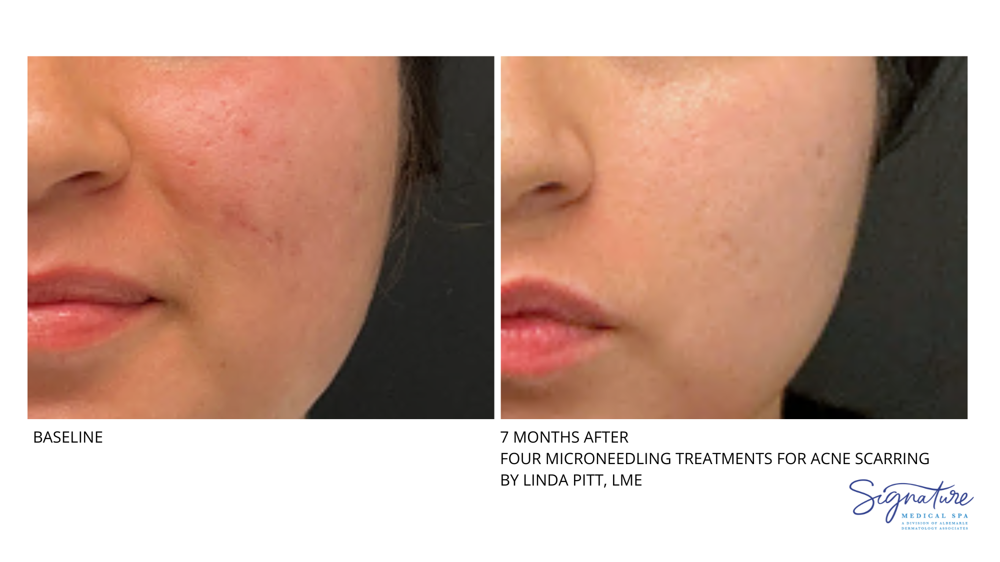 Before and After Image: Microneedling - front