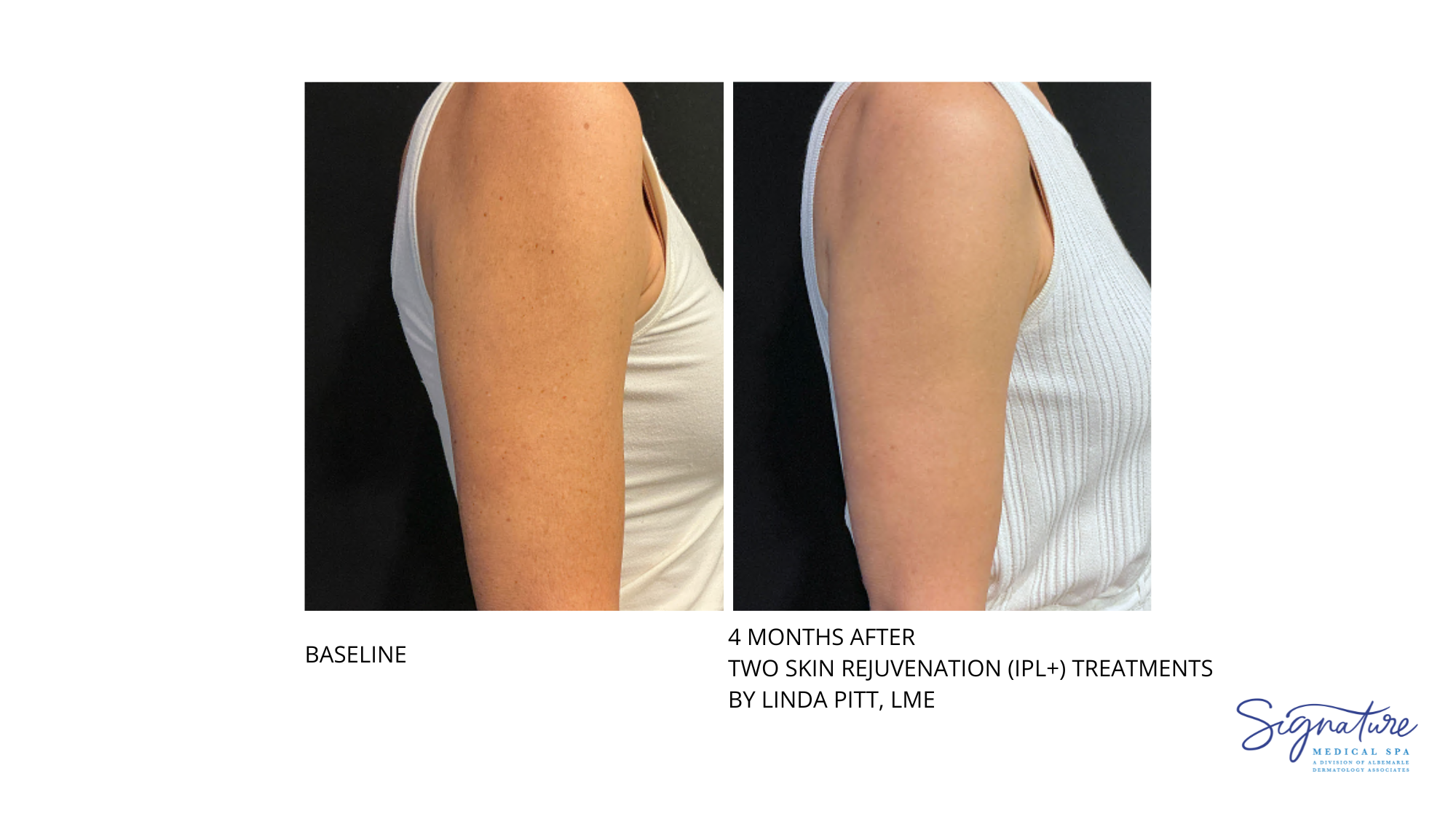 Before and After Image: Skin Rejuvenation (IPL+) - right-side