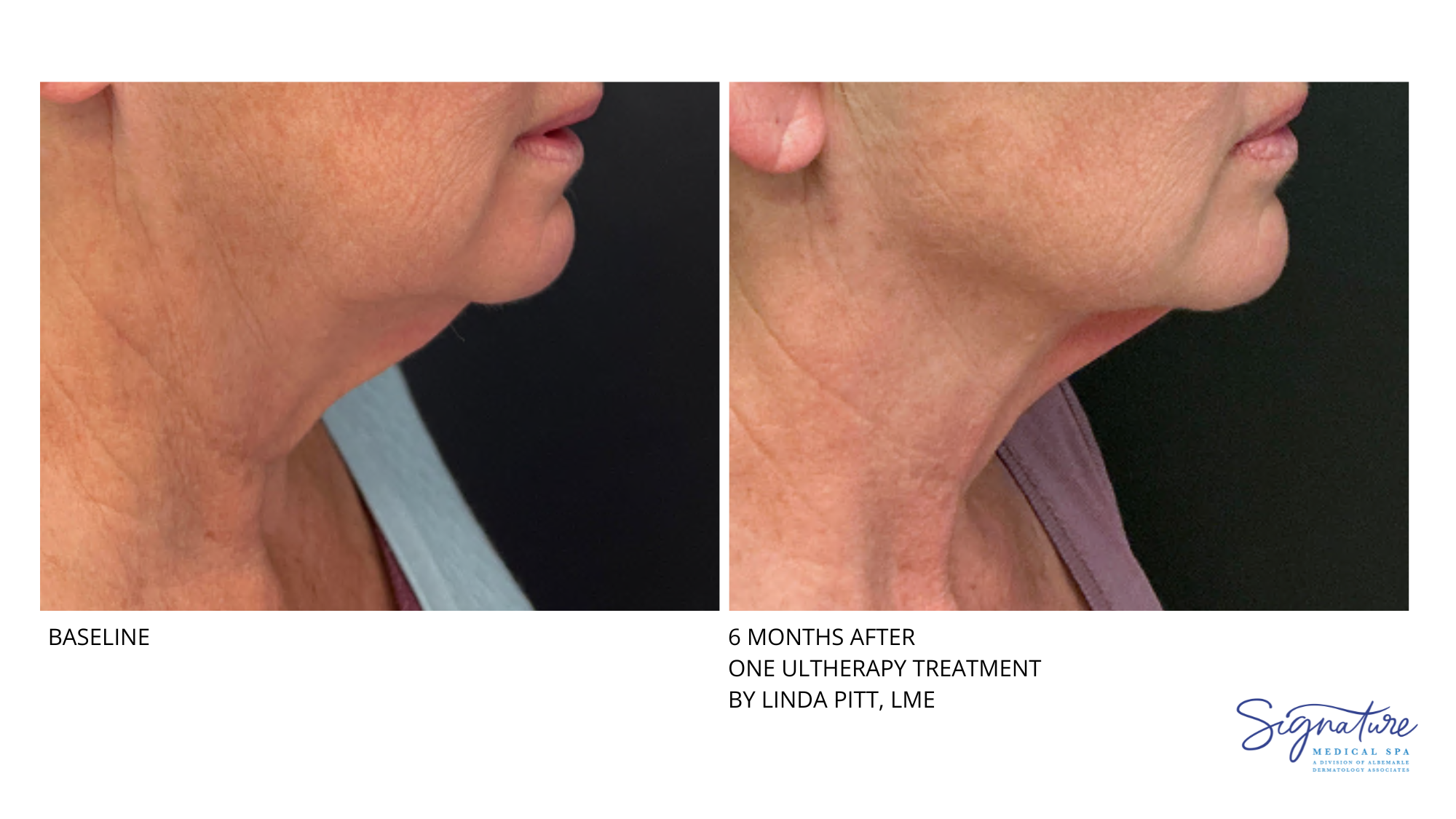 Before and After Image: Ultherapy - right-side