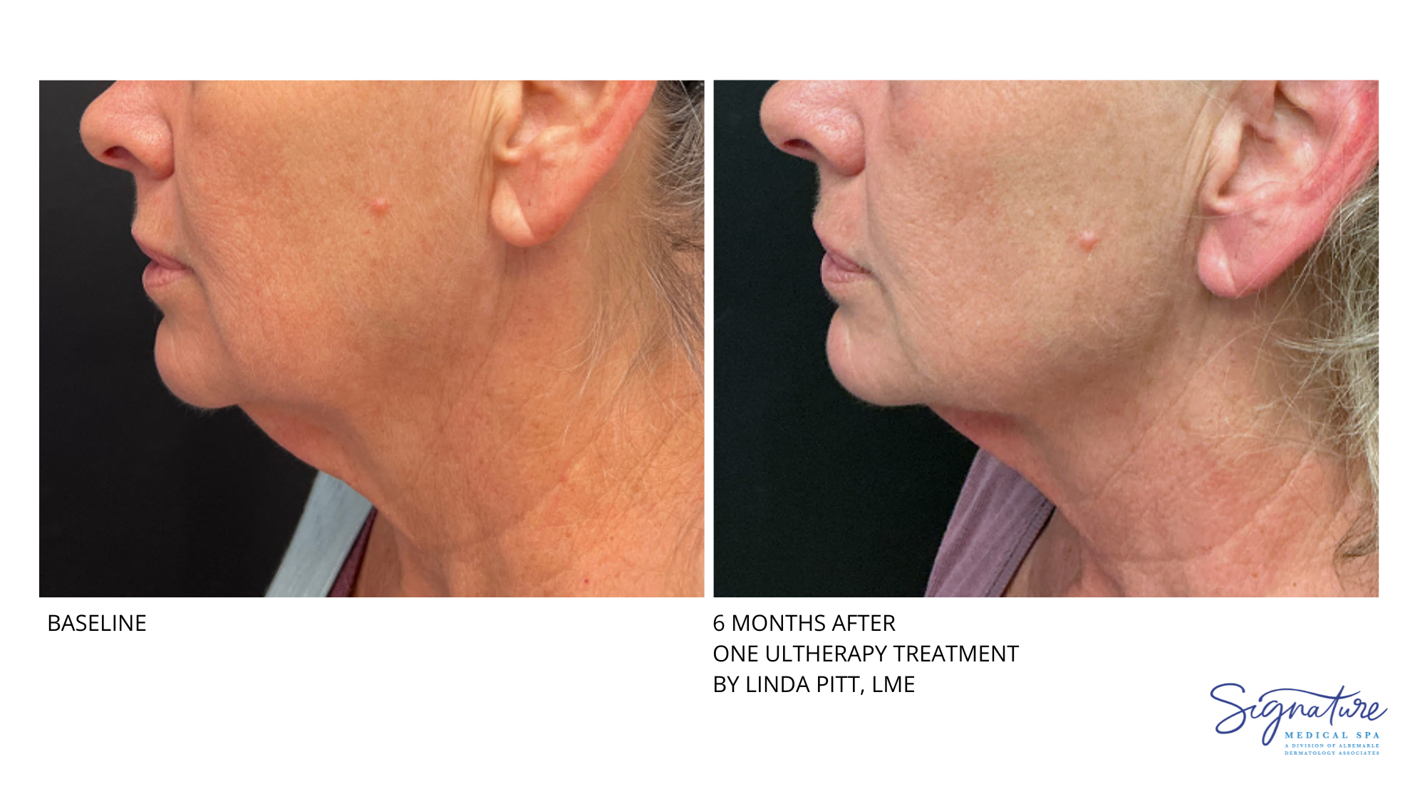 Before and After Image: Ultherapy - left-side