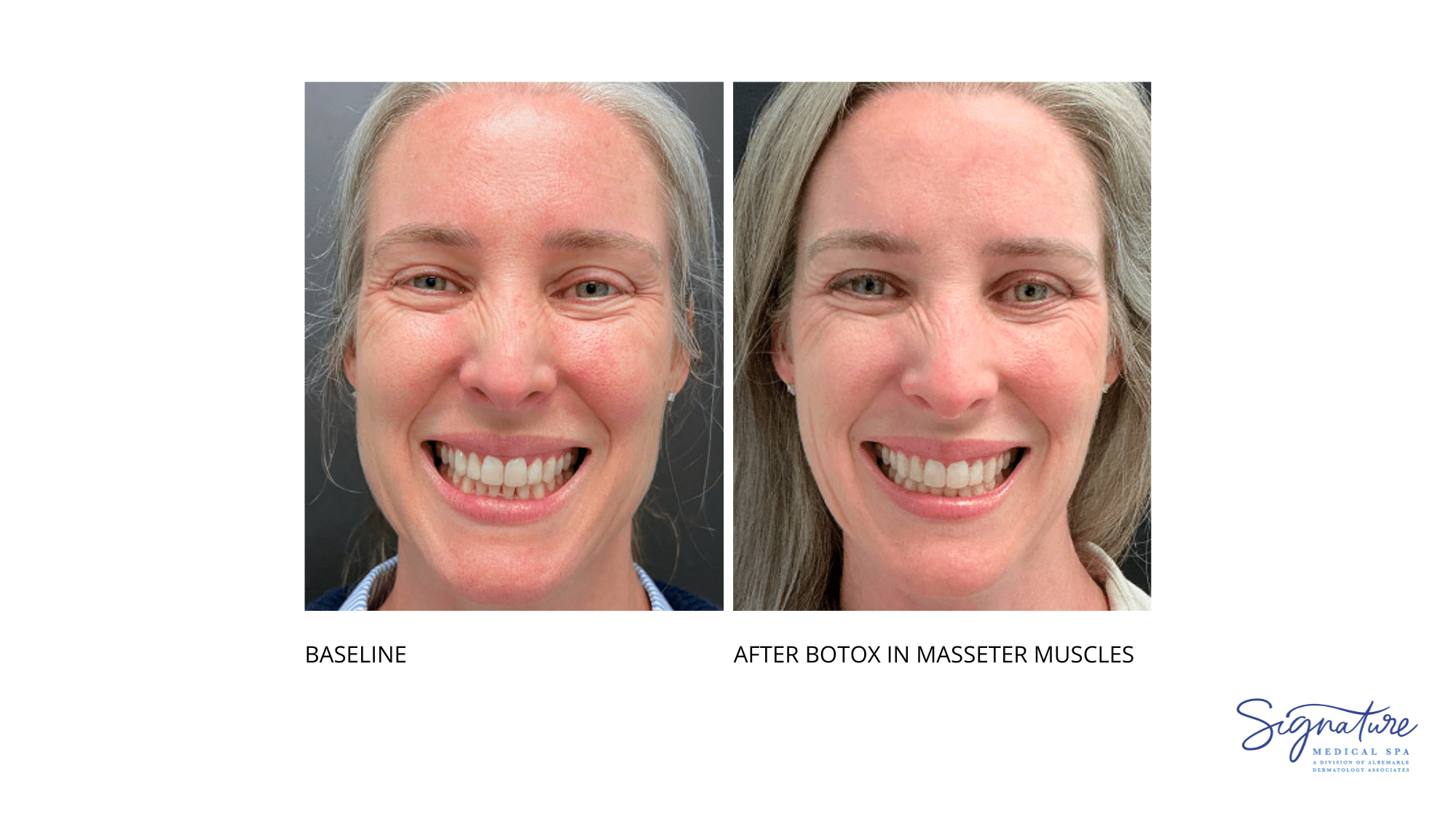 Before and After Image: Botox Cosmetic