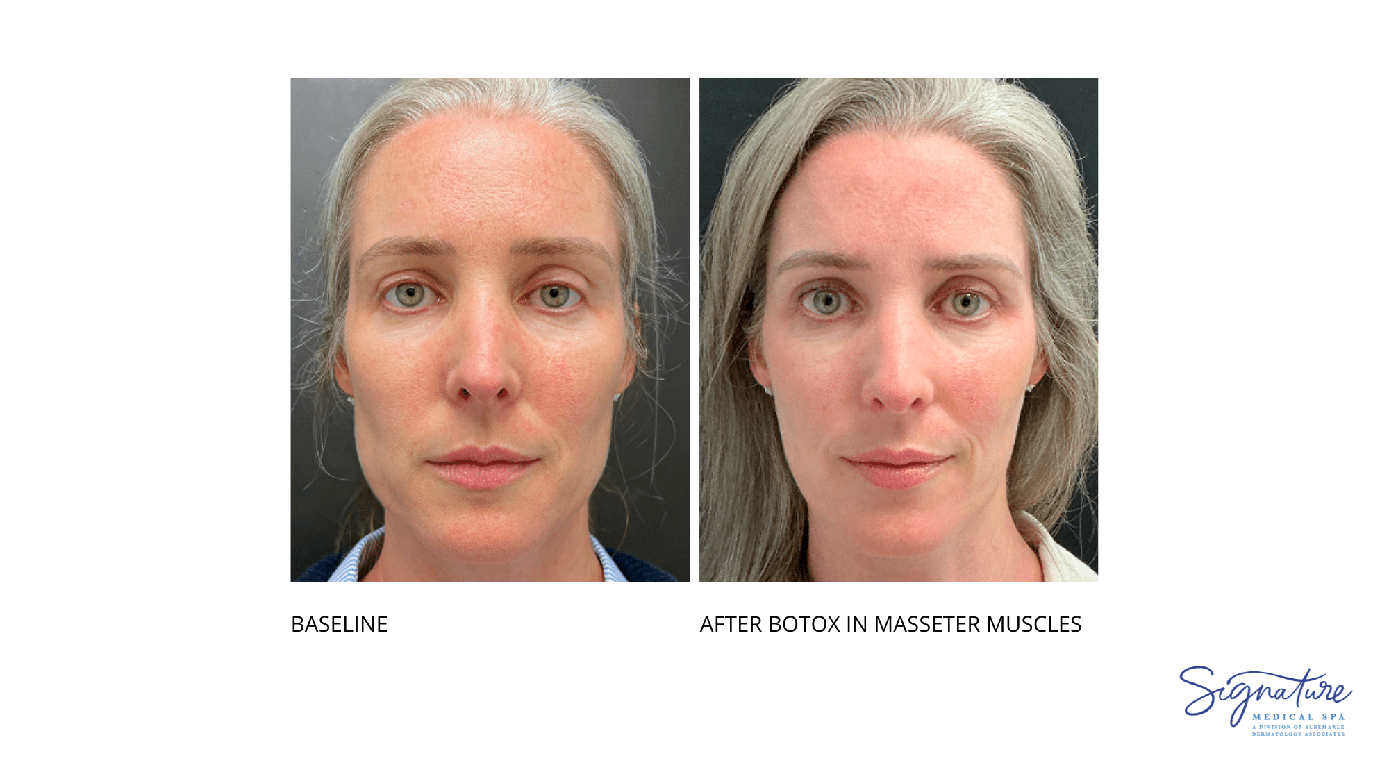 Before and After Image: Botox Cosmetic - front