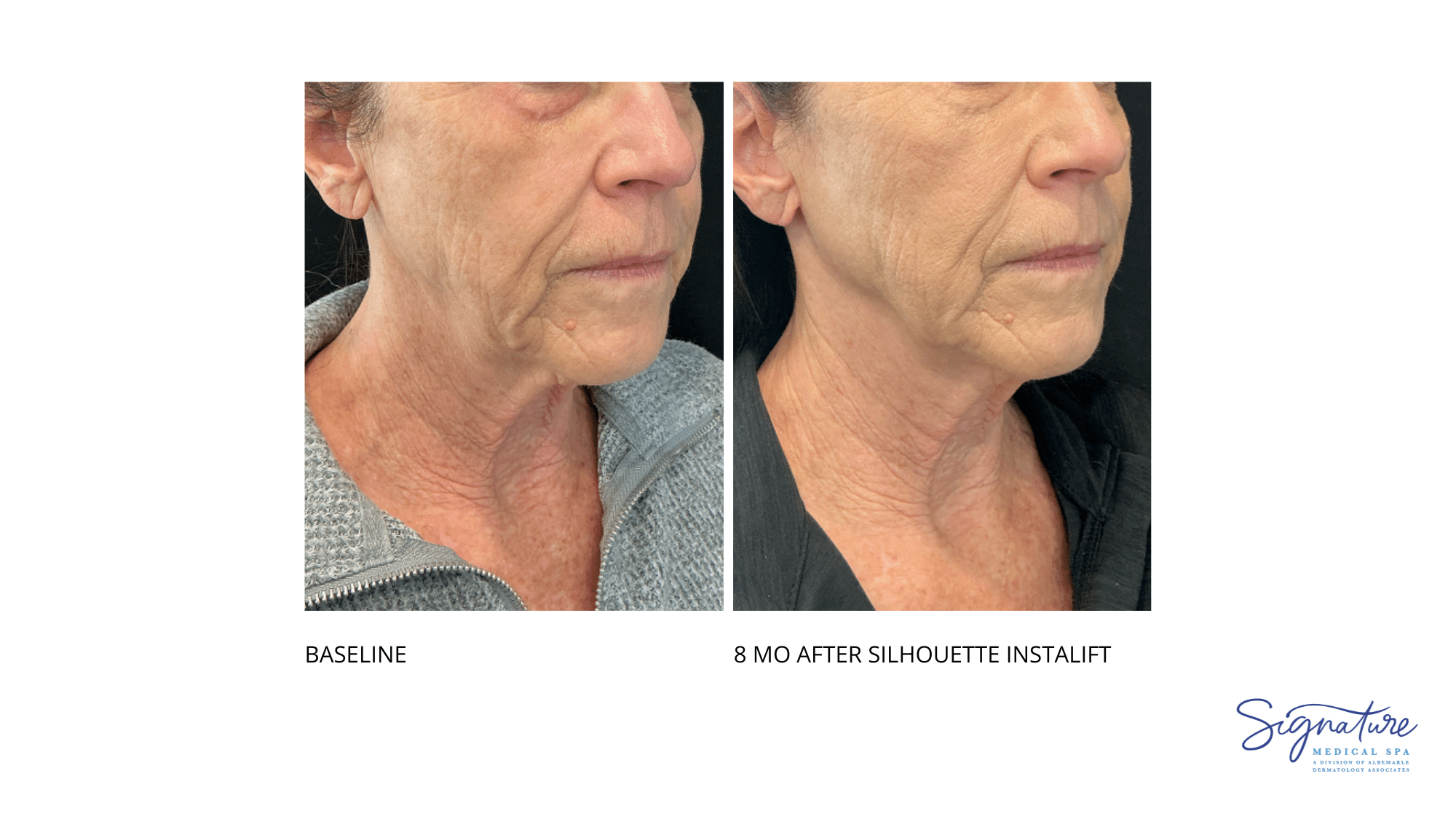 Before and After Image: Silhouette Instalift
