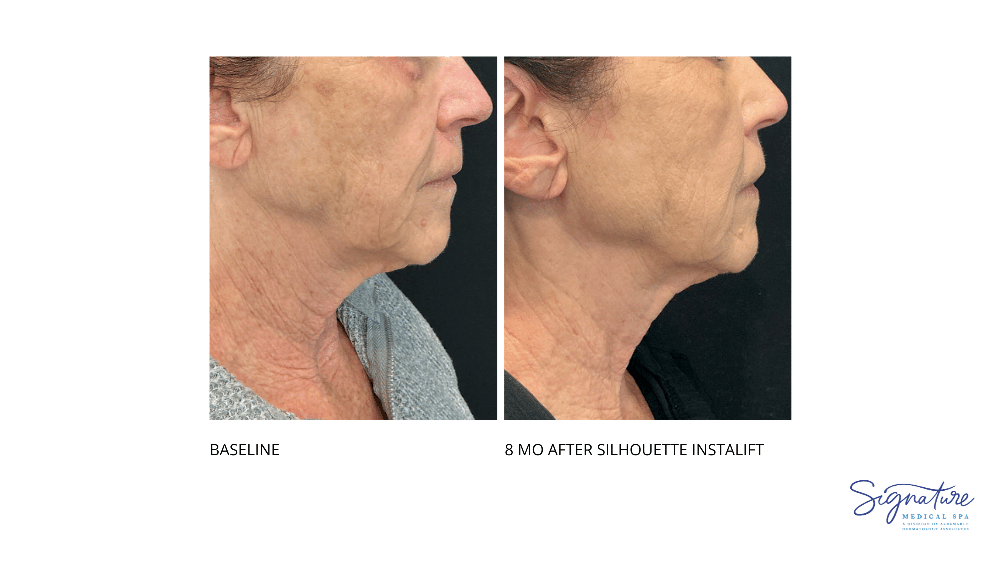 Before and After Image: Silhouette Instalift - right-side