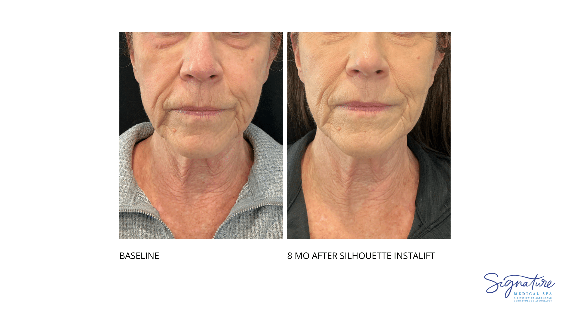 Before and After Image: Silhouette Instalift - front