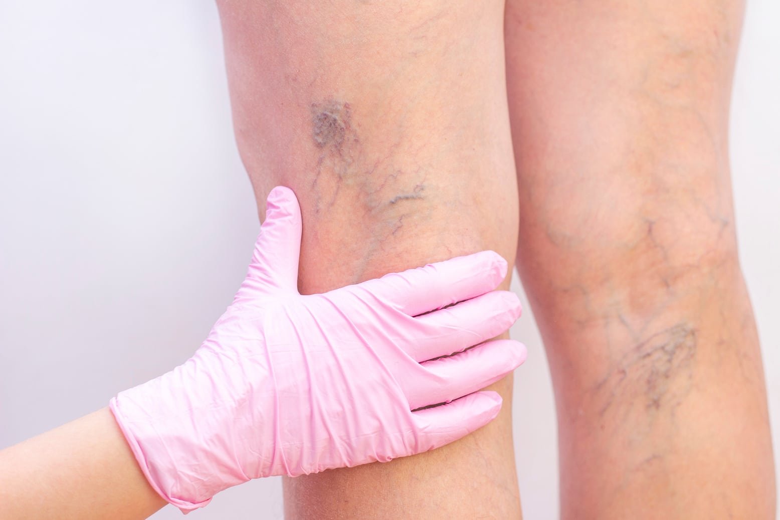 Leg Vein Treatments page on website 3