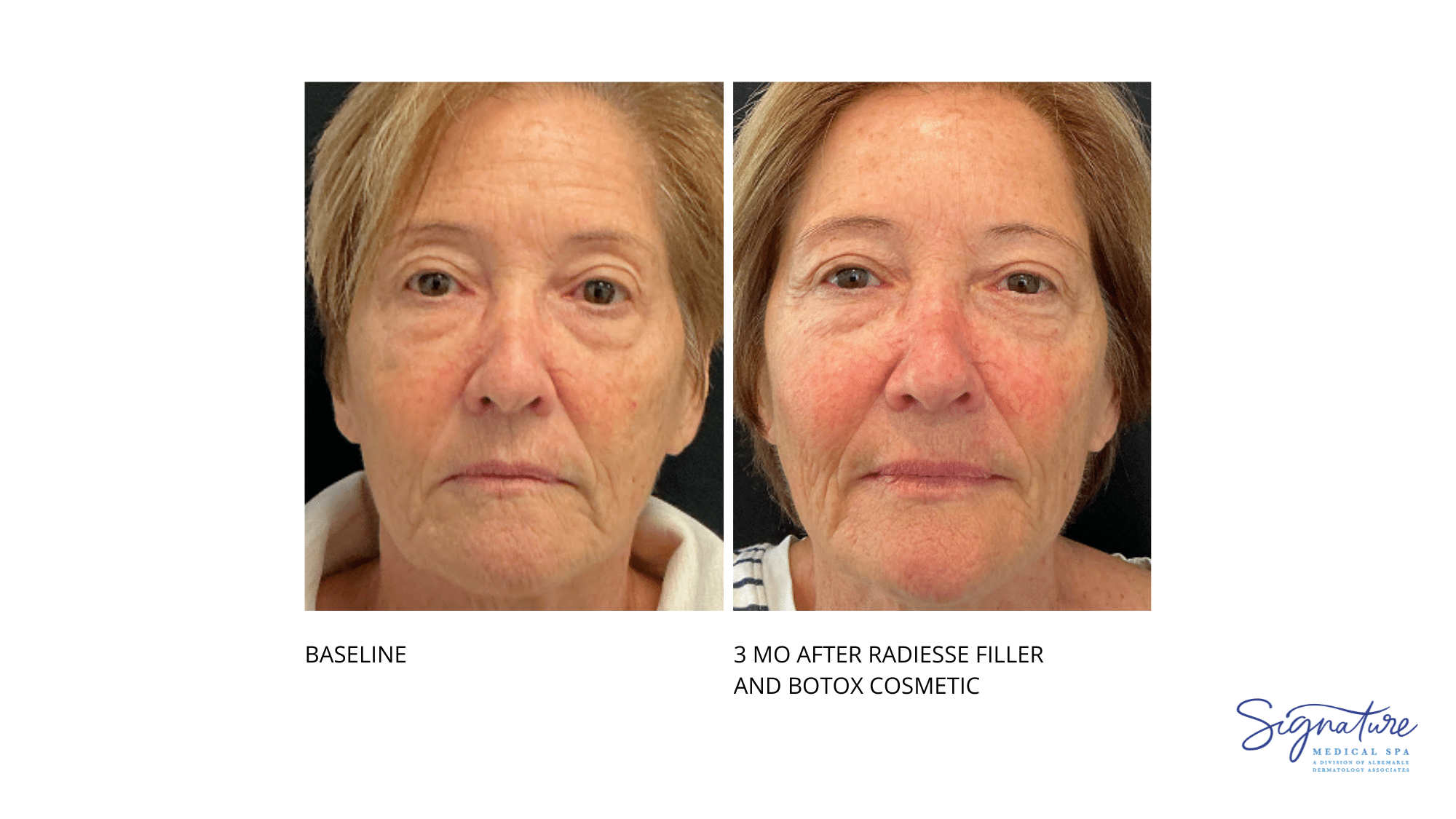 Before and After Image: Radiesse Filler and Botox Cosmetic