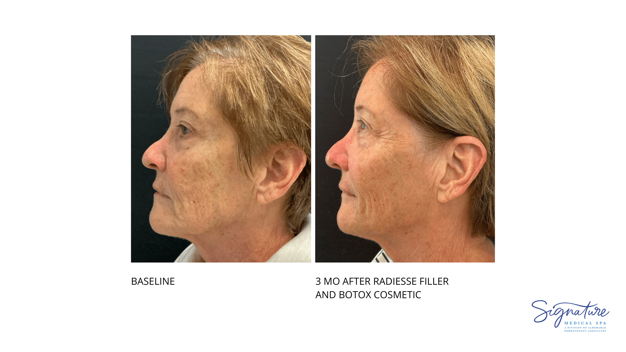 Before and After Image: Radiesse Filler and Botox Cosmetic - left-side