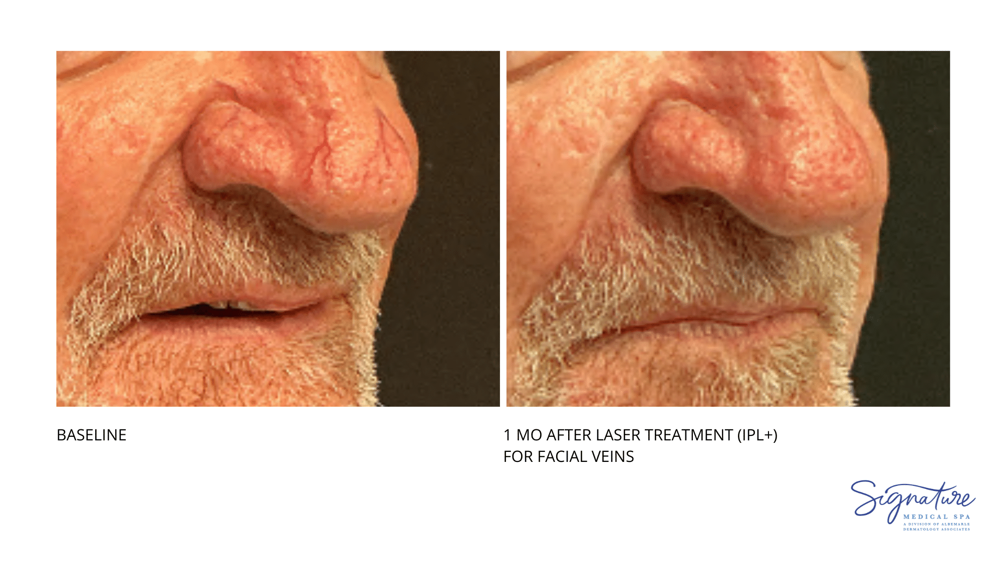 Before and After Image: Laser treatment - front