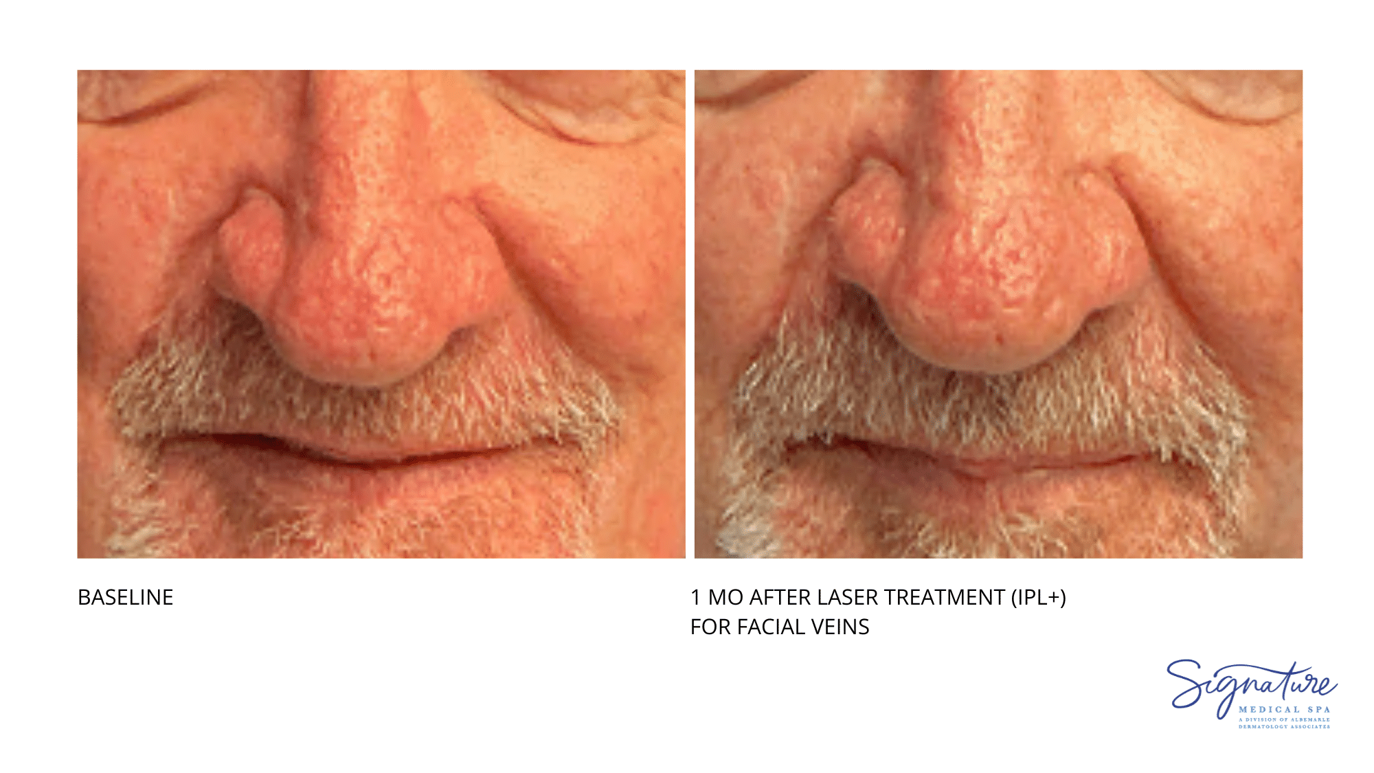 Before and After Image: Laser treatment -