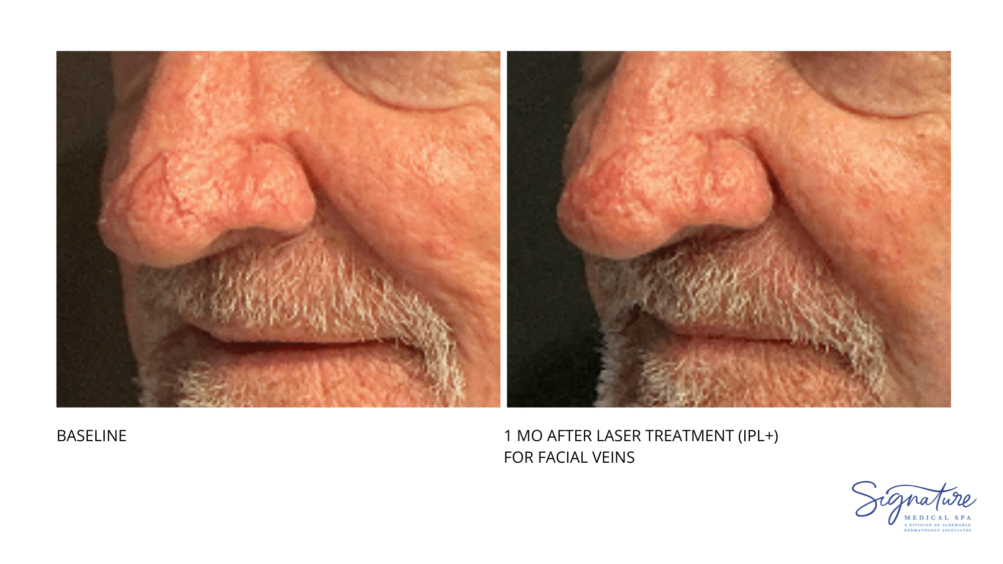 Before and After Image: Laser treatment -
