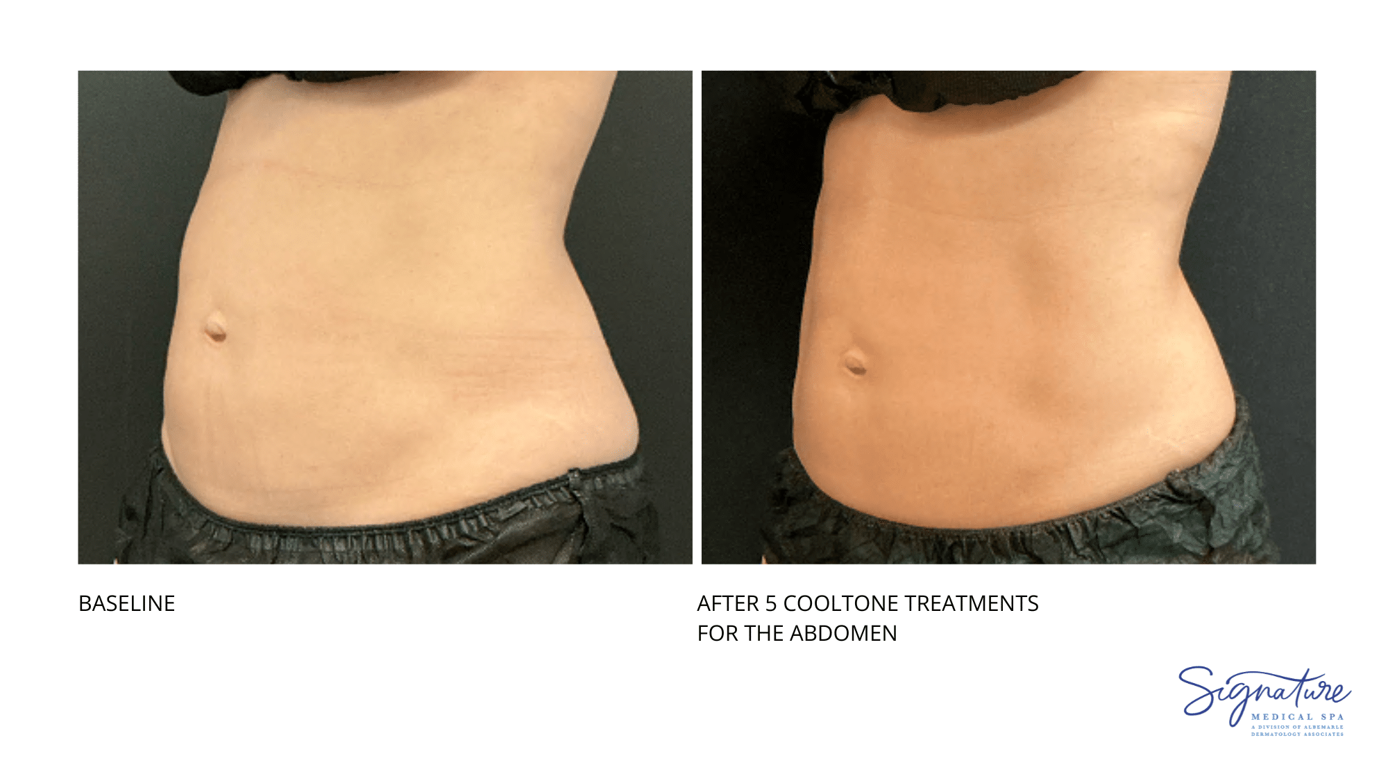 Before and After Image: Coolsculpting