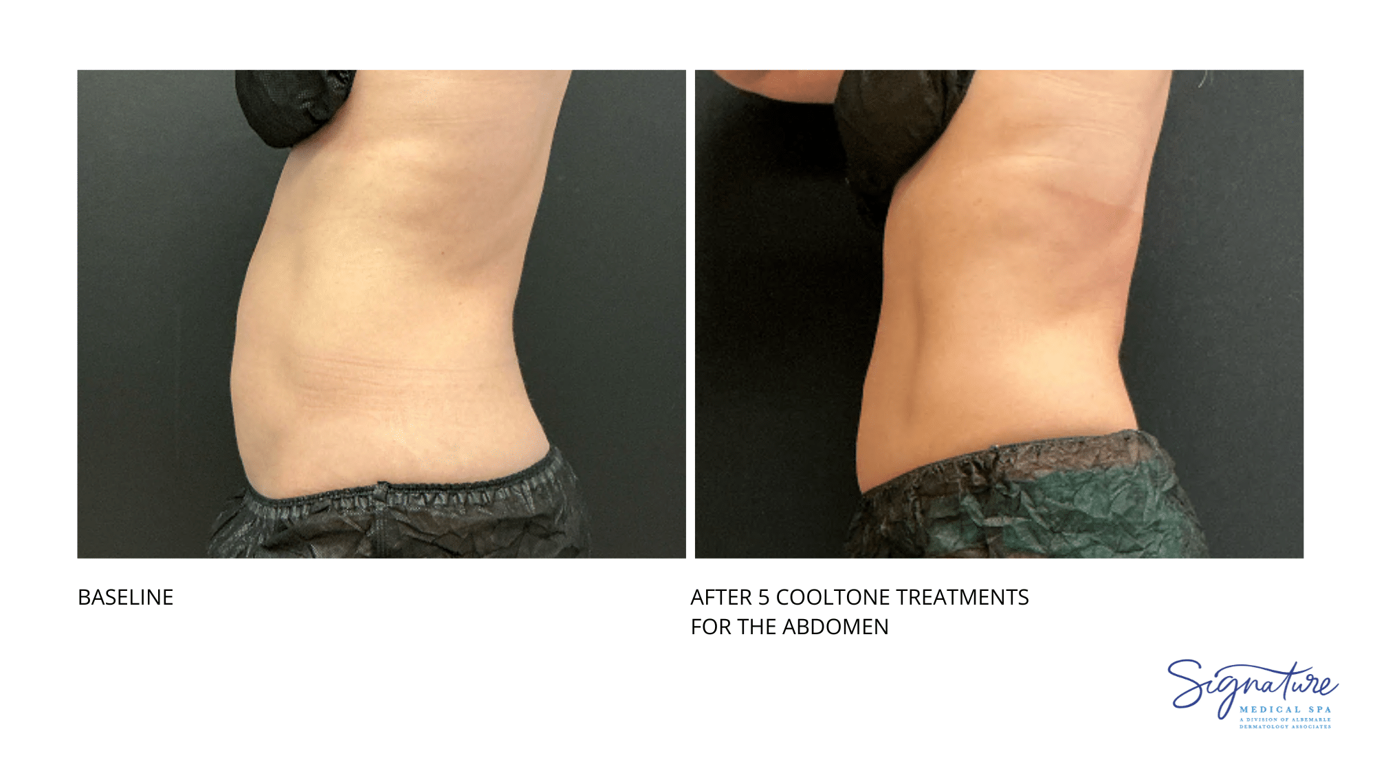 Before and After Image: Coolsculpting - front