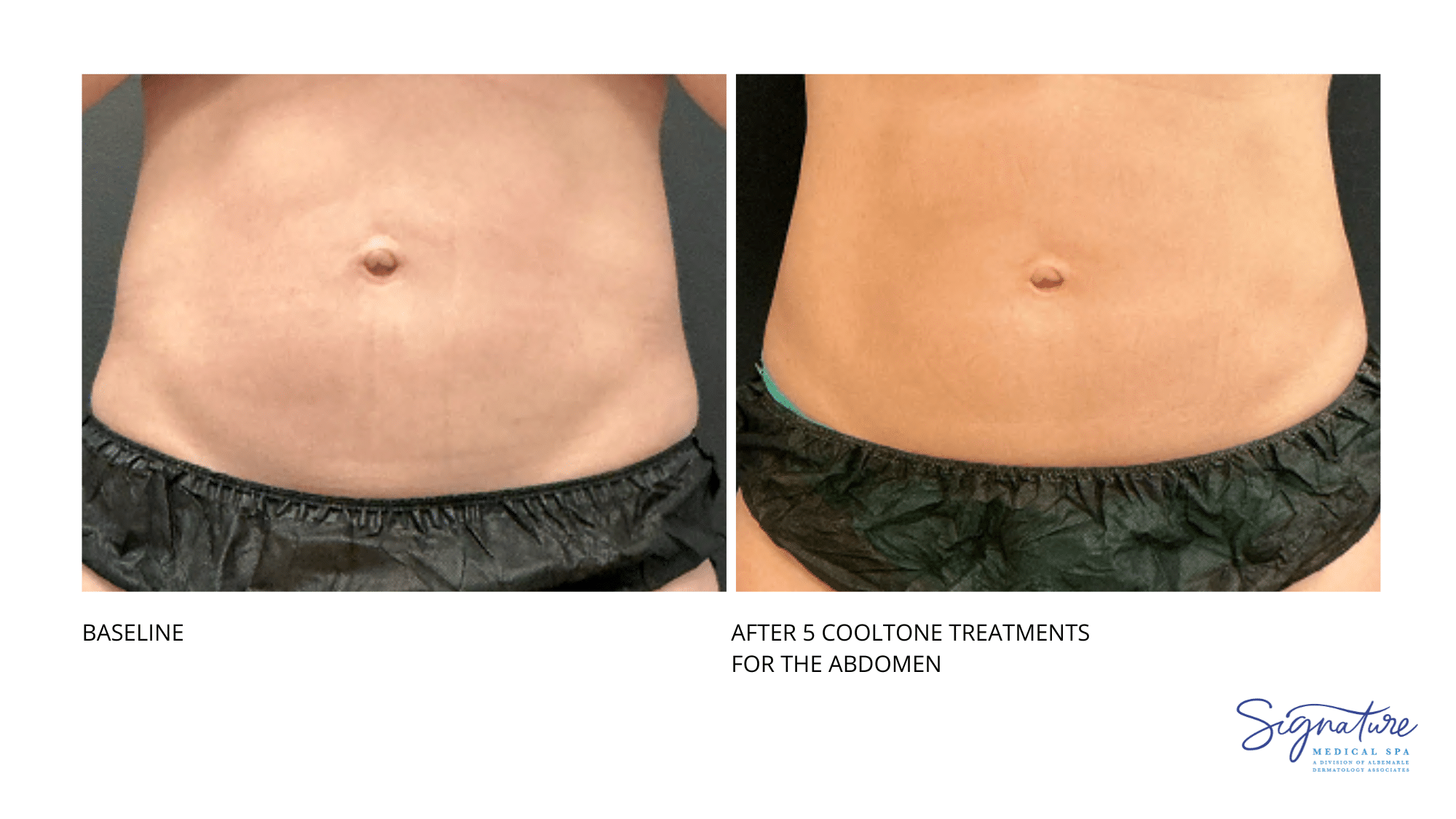 Before and After Image: Coolsculpting - front