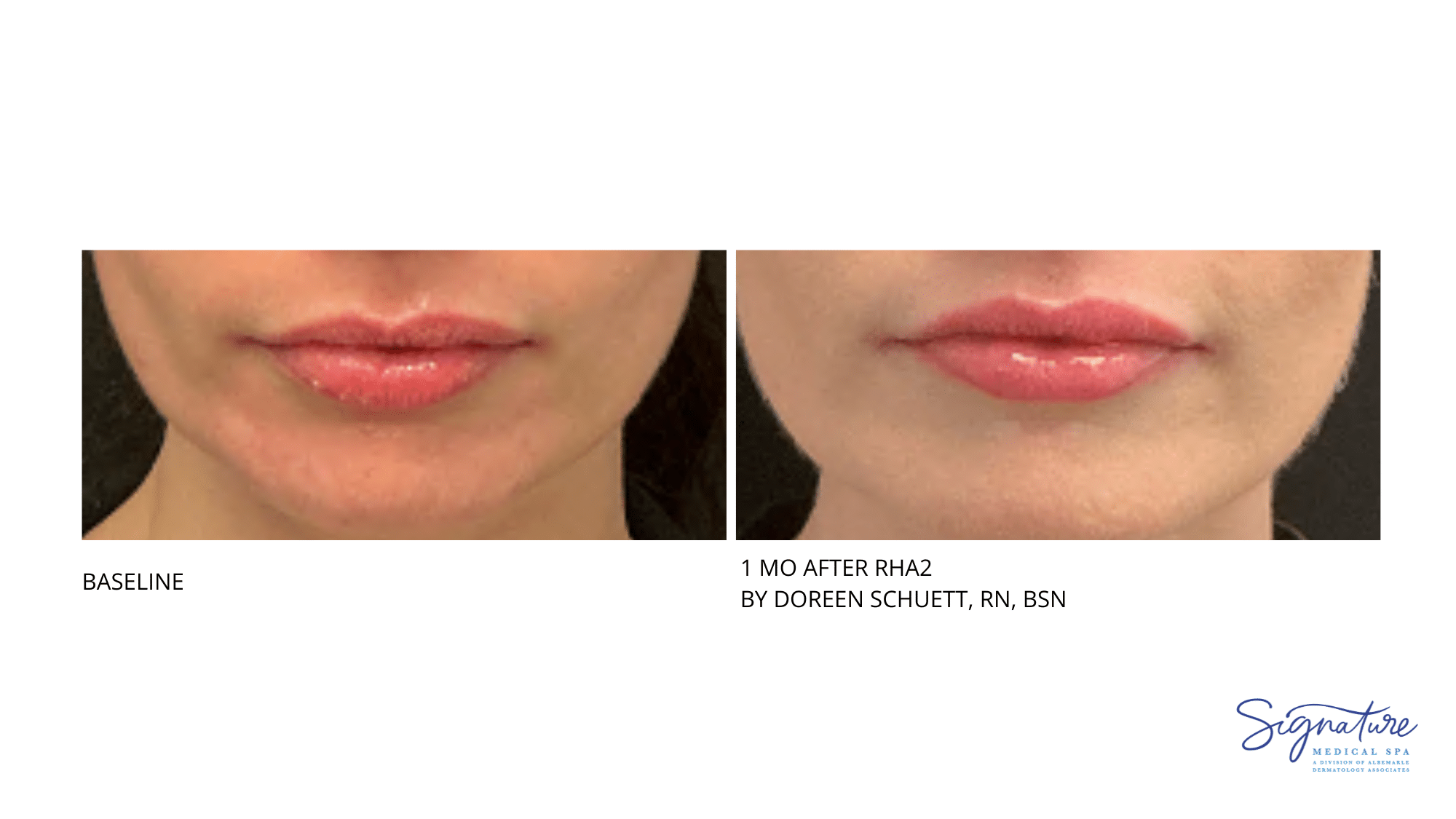 Before and After Image: RHA2 - front