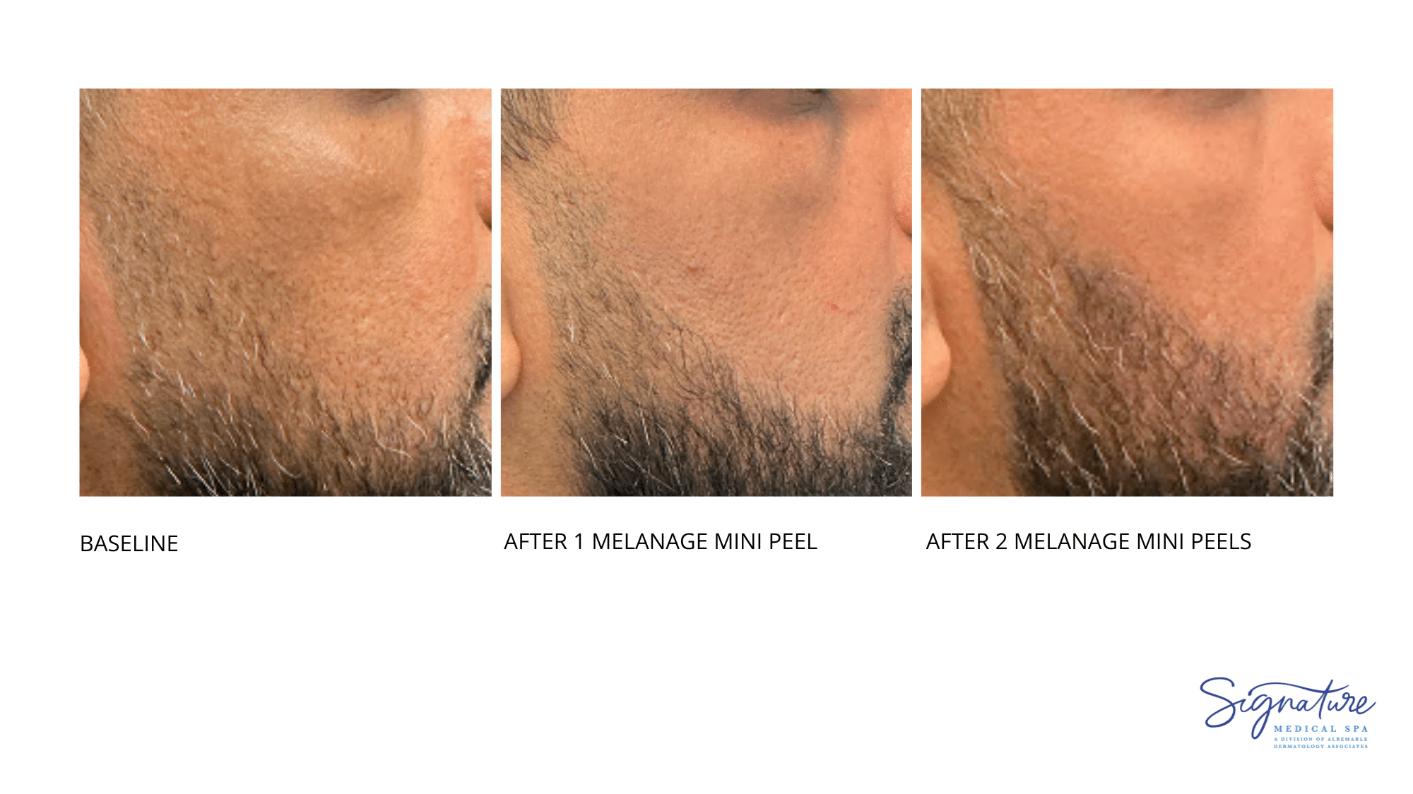 Before and After Image: Melanage Mini Peel - front
