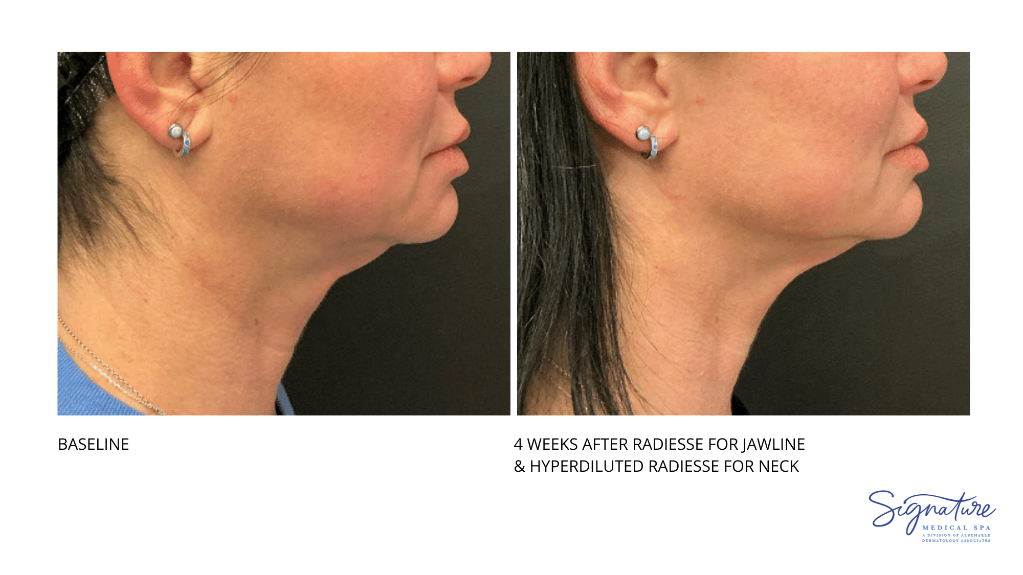 Before and After Image: Radiesse - right-side