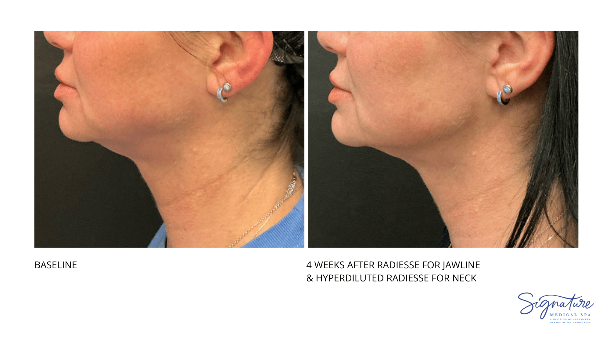 Before and After Image: Radiesse - left-side