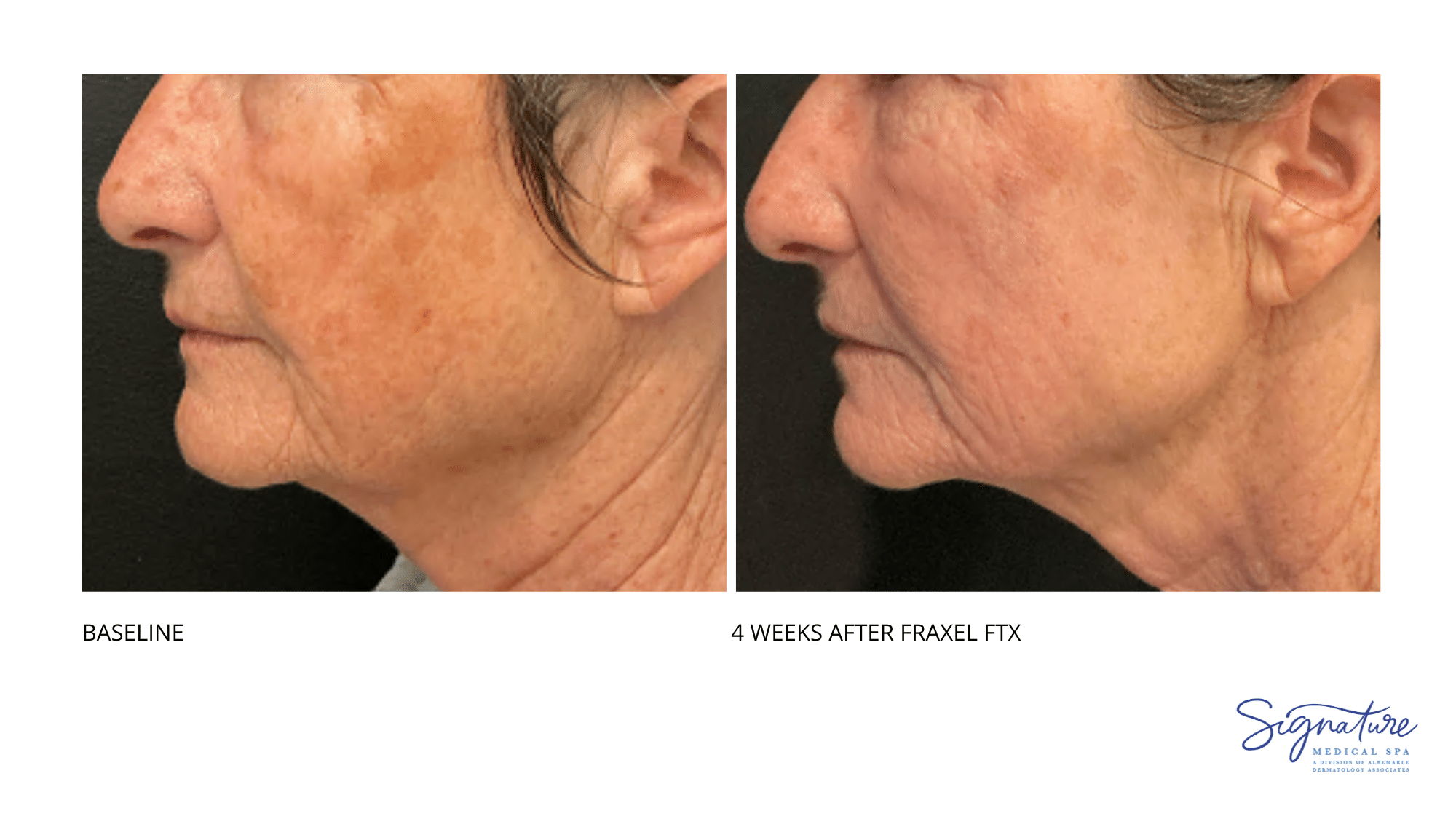 Before and After Image: Fraxel FTX - left-side