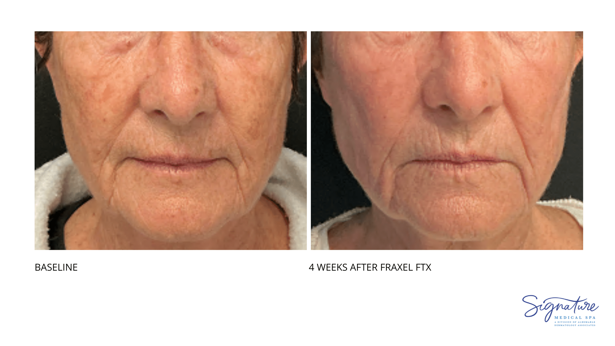 Before and After Image: Fraxel FTX - front