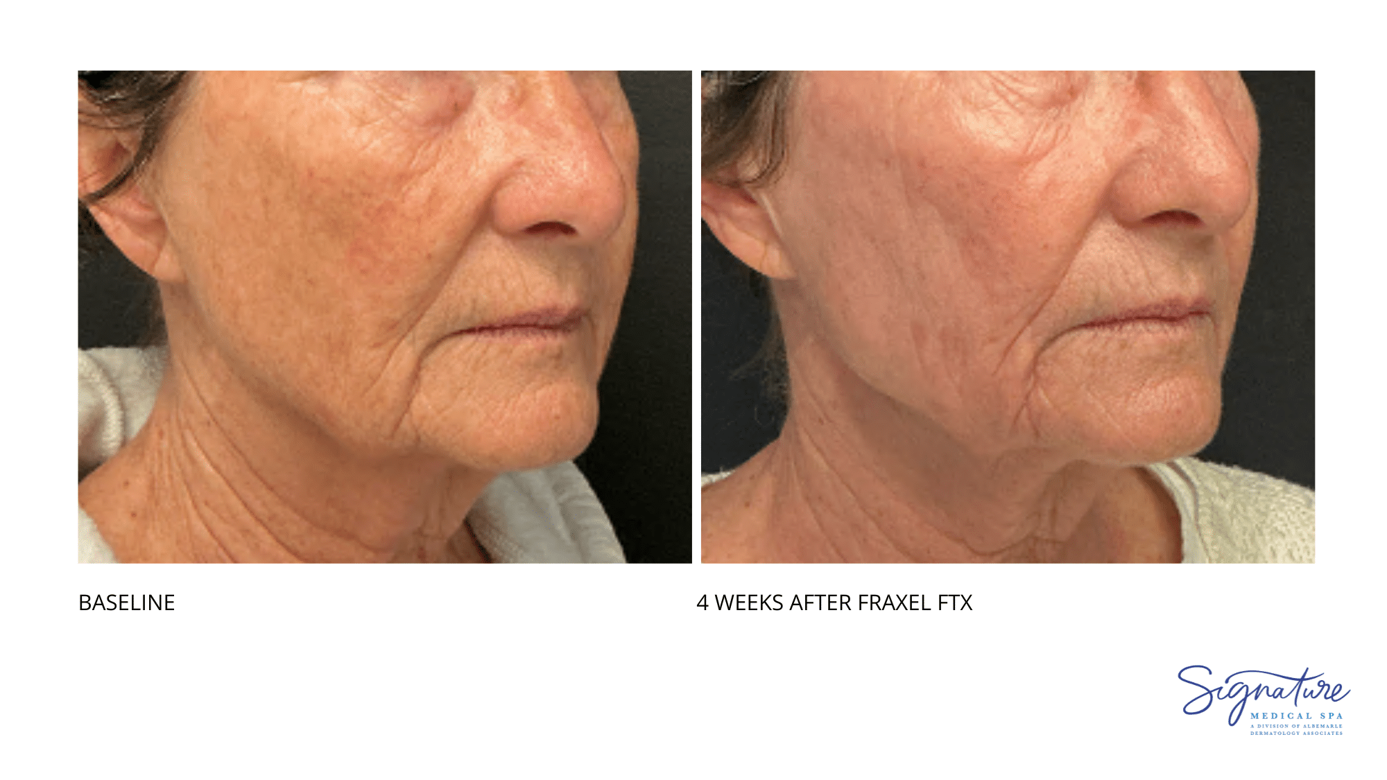 Before and After Image: Fraxel FTX - right-front-oblique