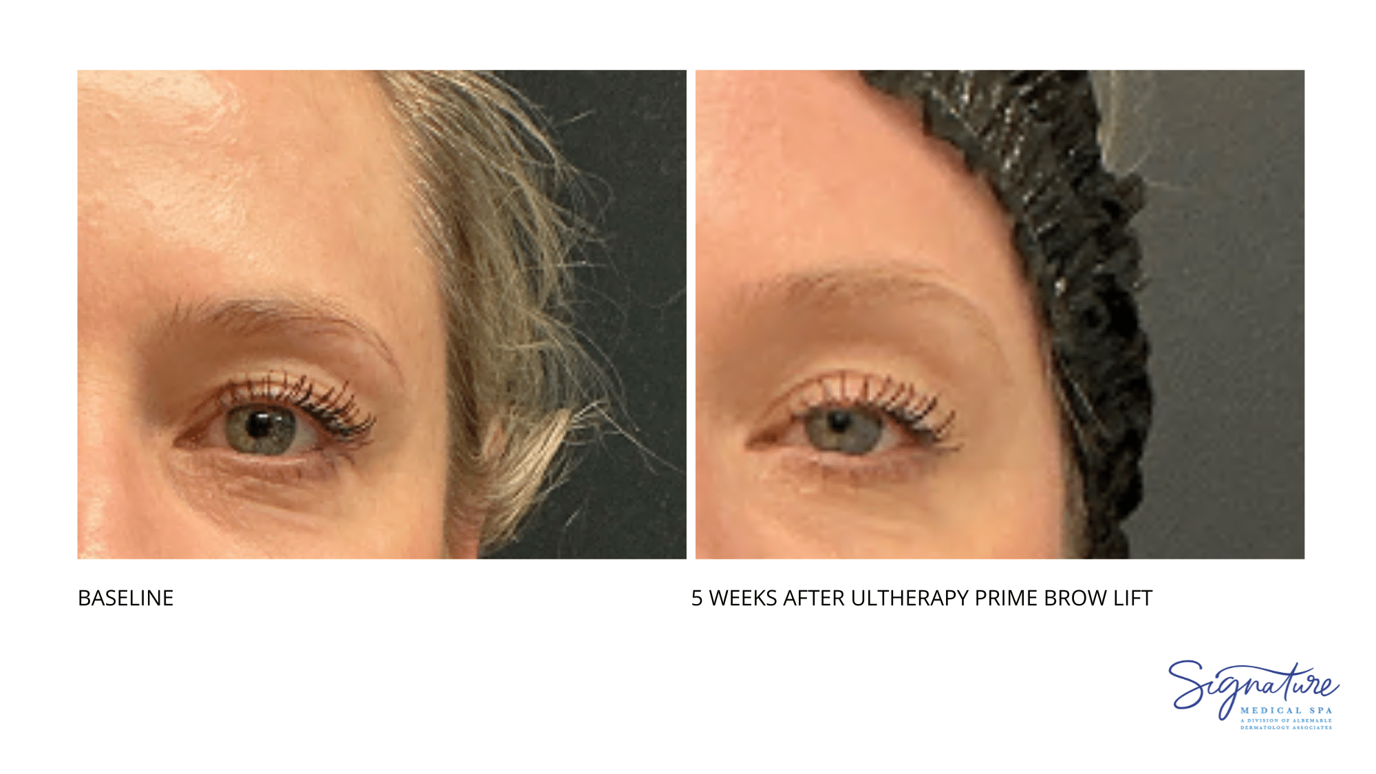 Before and After Image: Ultherapy Prime Brow Lift - front