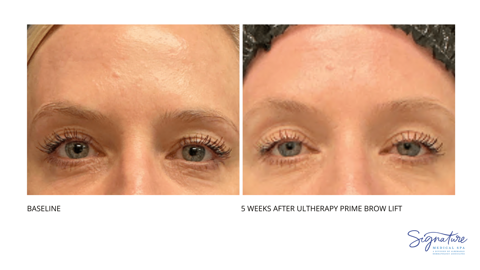 Before and After Image: Ultherapy Prime Brow Lift - front