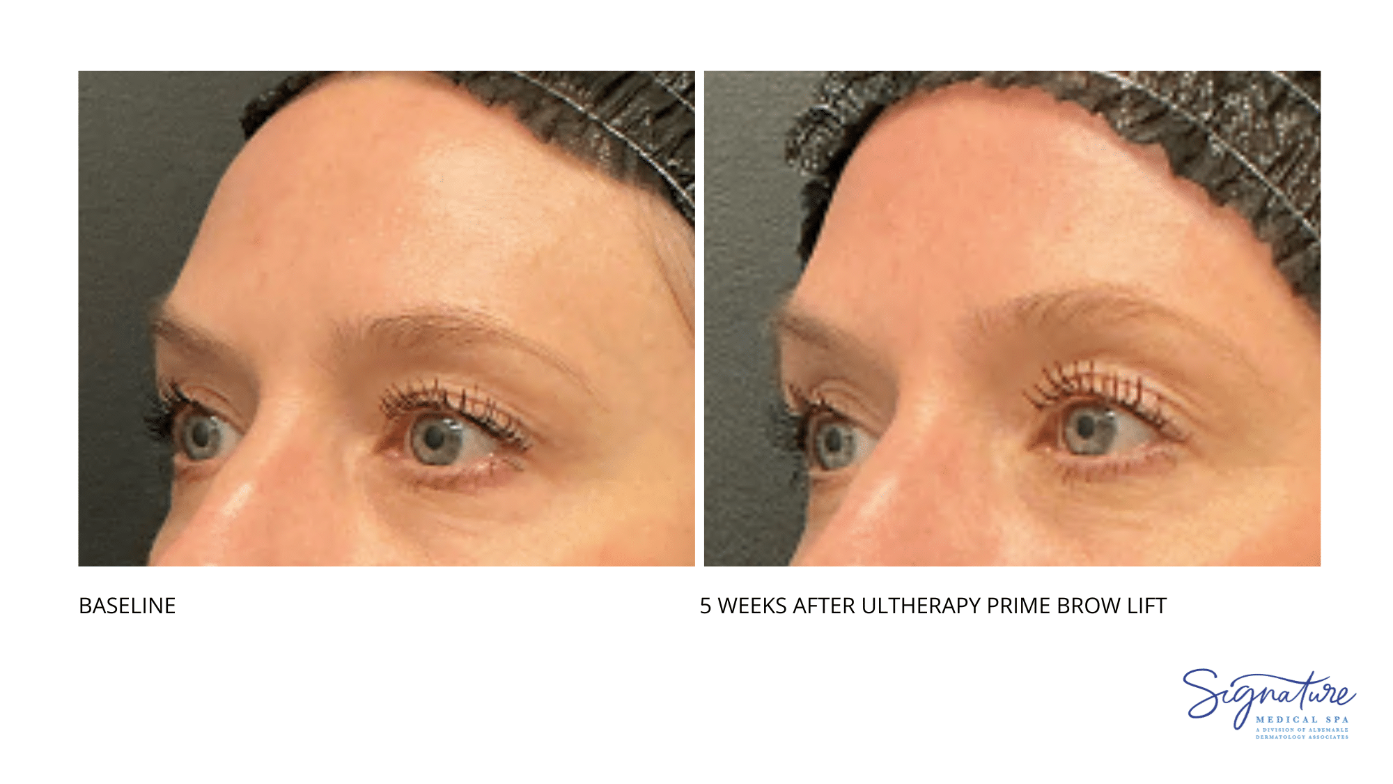 Before and After Image: Ultherapy Prime Brow Lift - left-front-oblique